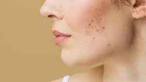 ખીલ (Pimples)