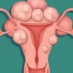 ગર્ભાશયના રોગો (Uterine Diseases)