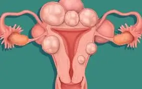 ગર્ભાશયના રોગો (Uterine Diseases)