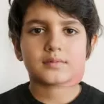 ગાલપચોળિયાં (Mumps)