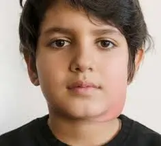 ગાલપચોળિયાં (Mumps)