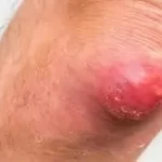 ગૂમડું (Boil)