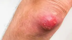 ગૂમડું (Boil)