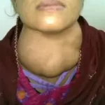 ગોઈટર (ગલગંડ) (Goiter)