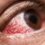 ઝામર (Glaucoma)