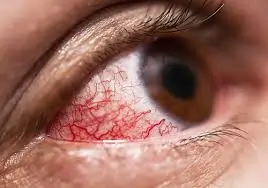 ઝામર (Glaucoma)