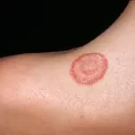 દાદર (Ringworm)