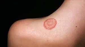 દાદર (Ringworm)