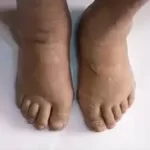 પગનો સોજો (Foot Edema)