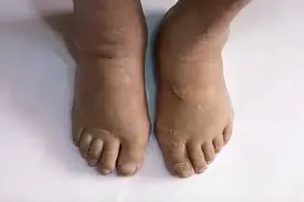 પગનો સોજો (Foot Edema)