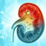 પથરી (કિડનીની) (Kidney Stones)