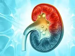 પથરી (કિડનીની) (Kidney Stones)