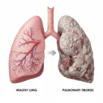 પલ્મોનરી ફાઈબ્રોસિસ