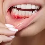 પાયોરિયા (Pyorrhea)