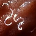 પેટમાં કરમિયા (Intestinal Worms)