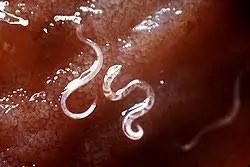 પેટમાં કરમિયા (Intestinal Worms)