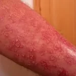 પેલેગ્રા (Pellagra)