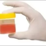 પેશાબમાં લોહી આવવું (Hematuria)