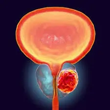 પ્રોસ્ટેટ કેન્સર (Prostate Cancer)