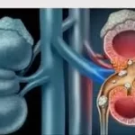 પ્રોસ્ટેટની સમસ્યા (Prostate Problem)