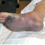 પ્લેગ (Plague)