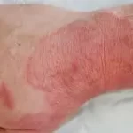 ફંગલ ઇન્ફેક્શન (Fungal Infection)