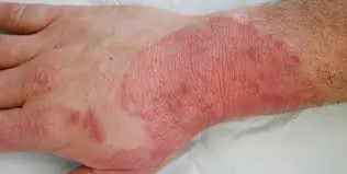 ફંગલ ઇન્ફેક્શન (Fungal Infection)