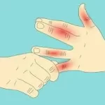 બેરીબેરી (Beriberi)