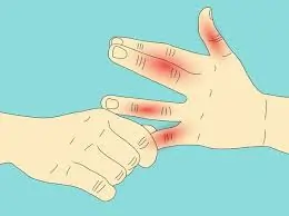 બેરીબેરી (Beriberi)