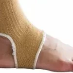 મચકોડ (Sprain)