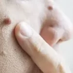 મસા (ચામડી પર) (Warts)