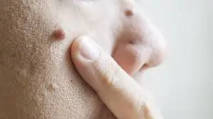 મસા (ચામડી પર) (Warts)