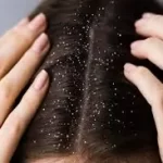માથાનો ખોડો (Dandruff)