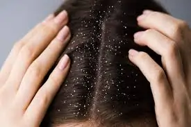 માથાનો ખોડો (Dandruff)