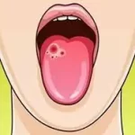 મોઢાનું કેન્સર (Oral Cancer)