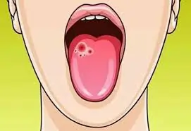 મોઢાનું કેન્સર (Oral Cancer)