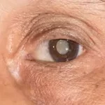 મોતિયો (Cataract)