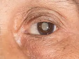 મોતિયો (Cataract)