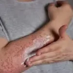 રક્તપિત્ત (Leprosy)