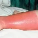 રતવા (Erysipelas)