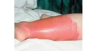 રતવા (Erysipelas)