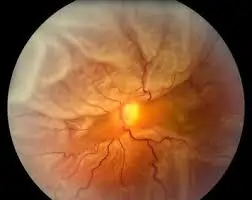 રેટિનાની તકલીફ (Retinal Detachment)