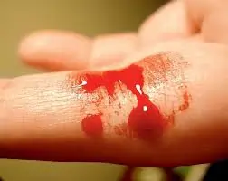લોહી વહેવું (Bleeding)