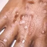 શીતળા (Smallpox)