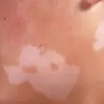 સફેદ ડાઘ (Vitiligo)
