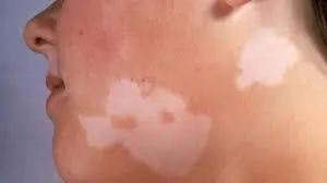 સફેદ ડાઘ (Vitiligo)