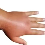 સોજો (Edema)