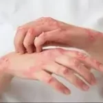 સોરાયસીસ (Psoriasis)