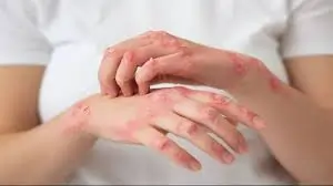સોરાયસીસ (Psoriasis)