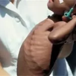 સ્કરવી (Scurvy)